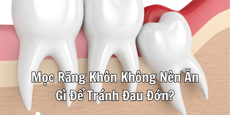 Mọc Răng Khôn Không Nên Ăn Gì Để Tránh Sưng, Đau 1 Mọc Răng Khôn Không Nên Ăn Gì Để Tránh Đau Đớn?