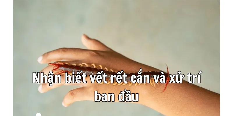 Bị Rết Cắn Không Nên Ăn Gì Và Cách Sơ Cứu Khi Bị Rết Cắn