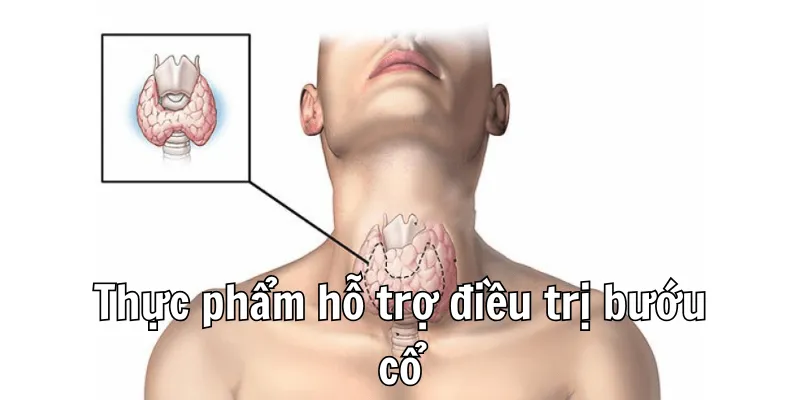 Bệnh Bướu Cổ Nên Kiêng Ăn Gì Để Hồi Phục Sức Khoẻ 2 1 2 min 15