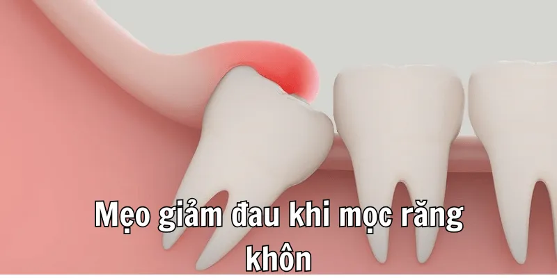 Mọc Răng Khôn Không Nên Ăn Gì Để Tránh Sưng, Đau 3 1 3 min 6