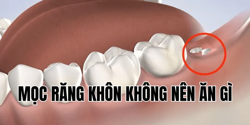 Mọc Răng Khôn Không Nên Ăn Gì Để Tránh Sưng, Đau 21 1 min 29