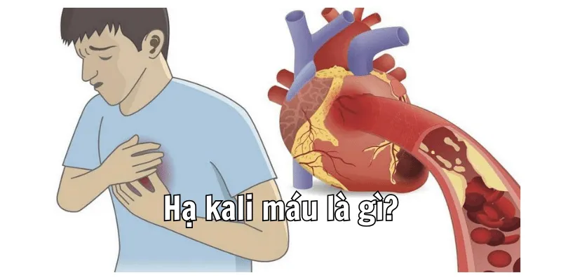 Hạ kali máu là tình trạng nghiêm trọng với sức khoẻ Hạ kali máu là tình trạng nghiêm trọng với sức khoẻ
