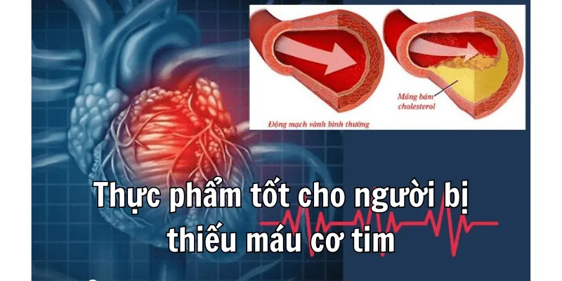 Thiếu Máu Cơ Tim Nên Ăn Gì Có Dinh Dưỡng Toàn Diện