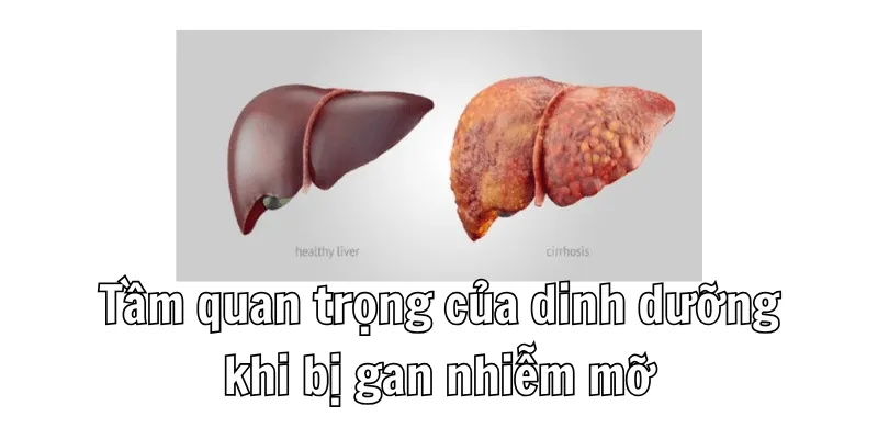 Bị Gan Nhiễm Mỡ Nên Ăn Gì - Hướng Dẫn Chi Tiết Cho Người Bệnh