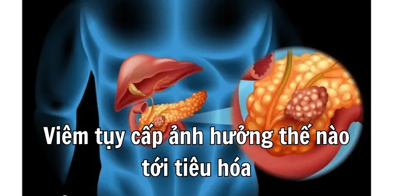 Bệnh Viêm Tụy Cấp Nên Ăn Gì Để Sức Khoẻ Ổn Định