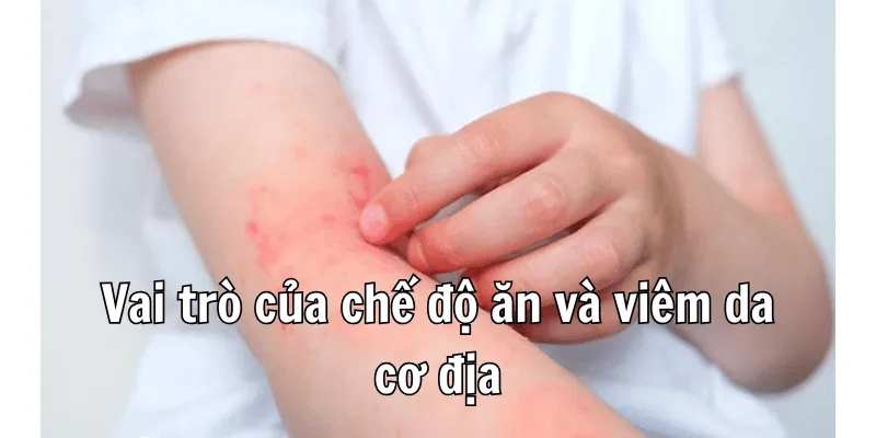 Viêm Da Cơ Địa Nên Ăn Gì Để Hỗ Trợ Điều Trị Hiệu Quả