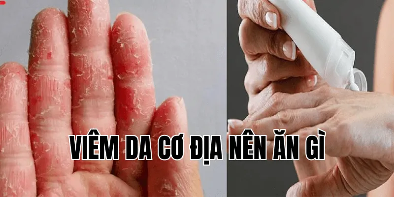 Viêm Da Cơ Địa Nên Ăn Gì Để Hỗ Trợ Điều Trị Hiệu Quả 29 3 min 32
